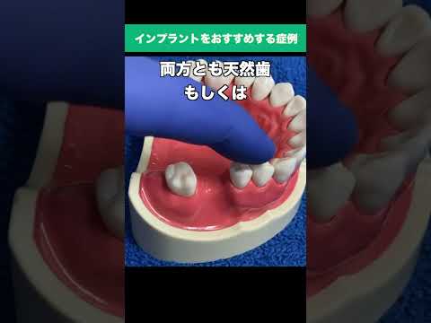 【戸塚駅前内藤歯科】抜歯後入れ歯は嫌！ブリッジかインプラントか症例をご紹介 #shorts #天然歯は大事