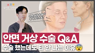 안면 거상 수술해도 효과 없는 사람 특징은? 효과 반토막 나는 이유, 의사도 놀란 이유❗_[삼사오 성형외과]