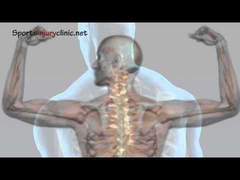 Shoulder Impingement Syndrome - Shoulder pain - Explained in a Minute