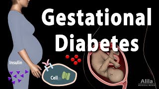 Gestational Diabetes, Animation