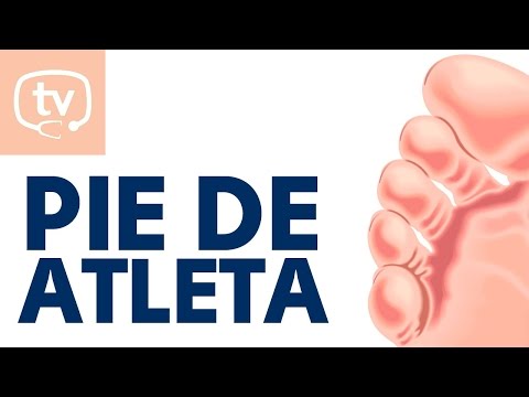 El pie de atleta (hongos en los pies)