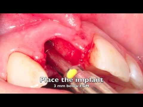 Implanty -korona tymczasowa