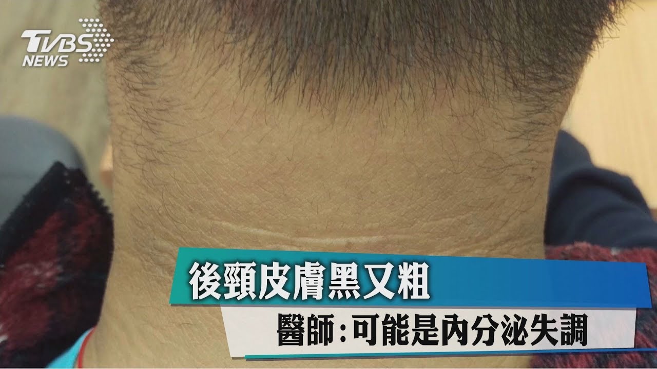 後頸皮膚黑又粗 醫師:可能是內分泌失調