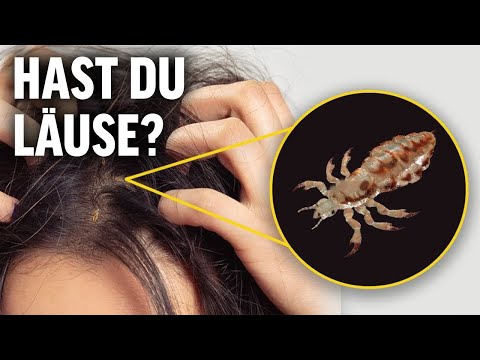 Kopfläuse: Warum gibt es sie, wie überleben sie und wie wir man sie los?