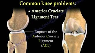 Knee Pain , common causes- Everything You Need To Know - Dr. Nabil Ebraheim