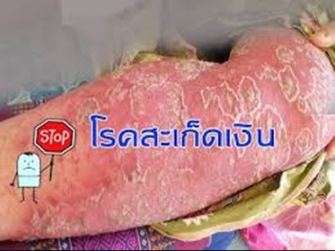 โรคสะเก็ดเงินครีมฮอร์โมน โรคสะเก็ดเงินบนพื้นของเด็ก