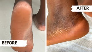 Say Goodbye to Rough Feet Learn to Remove Dead Skin at Home