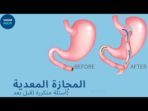 الأسئلة المتداولة حول تحويل مسار المعدة