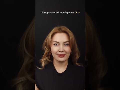 Op. Dr. Ayşe Karakaya | Eskişehir Nose Aesthetics | #Rhinoplasty #NoseAesthetics #Discover #HealthTourism