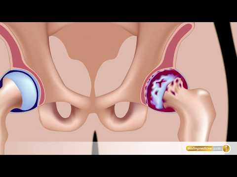 Wie werden als Magenschmerzen behandelt und den unteren Rücken Prämenopausalen Gelenke