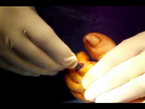 Cadde colpito posteriore della testa sul collo mal di ghiaccio Negozio di osteocondrosi 2 cucchiai