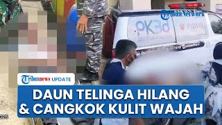 Derita Korban Ledakan SMAN 72 Jakut: Jari Diamputasi, Cangkok Kulit Wajah hingga Daun Telinga Hilang