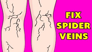 How to get rid of spider veins naturally in 3 minutes a day!