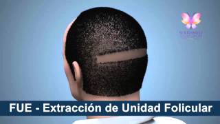 preview picture of video 'Tipos de transplante de pelo en El Paso, Texas, Las Cruces, New Mexico, Ciudad Juarez, Chihuahua'