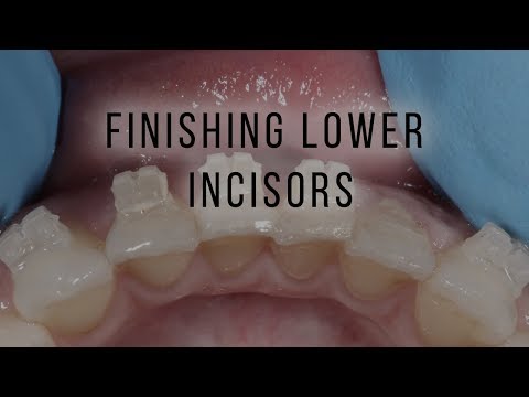 How to fix minor rotations on lower incisors with orthodontics