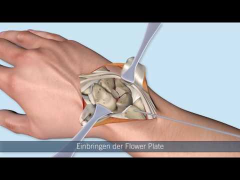 FlowerPlate by KLS Martin – Mediokarpale Teilarthrodese