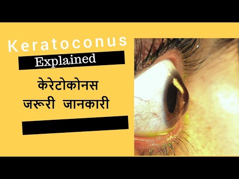 látás keratoconus helyreállítása a látás öregszik