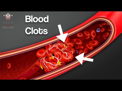, title : 'What You NEED to Know About Blood Clots...'