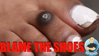 UH-OH, MY TOE IS TURNING BLACK!!! ***BEWARE OF TIGHT SHOES***