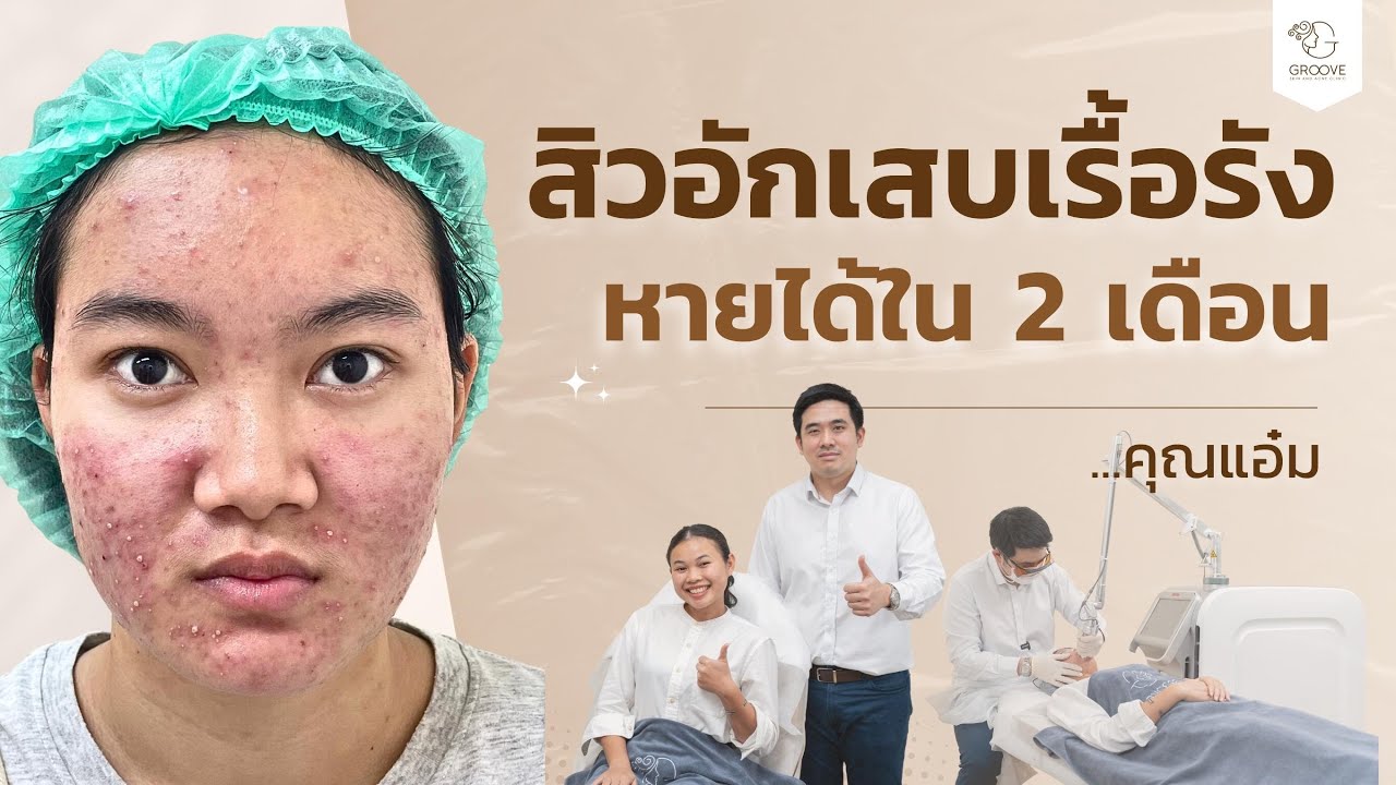 รีวิวรักษาสิว