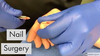 My thumbnail surgery for paronychia: partial avulsion with matrix ablation