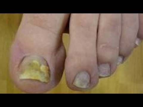 Ciuperca unghiilor de la picioare pentru îngrijirea pantofilor