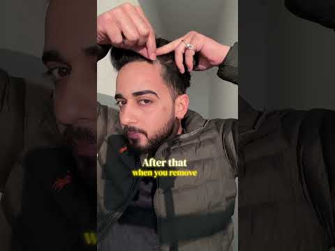 Solution for receding hairline #hairline #haircare #hairgrowth #skincare #perfecthair