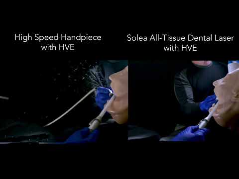 Solea All Tissue Laser Significant Reduction in Aerosols Splatter vs Drill 1 - Hawley Lane Dental