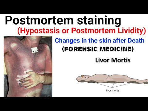 Postmortem Lividity | livor mortis | changes in the skin after death | Postmortem staining