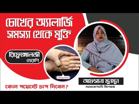 চোখের এল্যার্জি সমস্যা থেকে মুক্তির সমাধান। Dr Afsana Munmun। Afsana Nature Cure