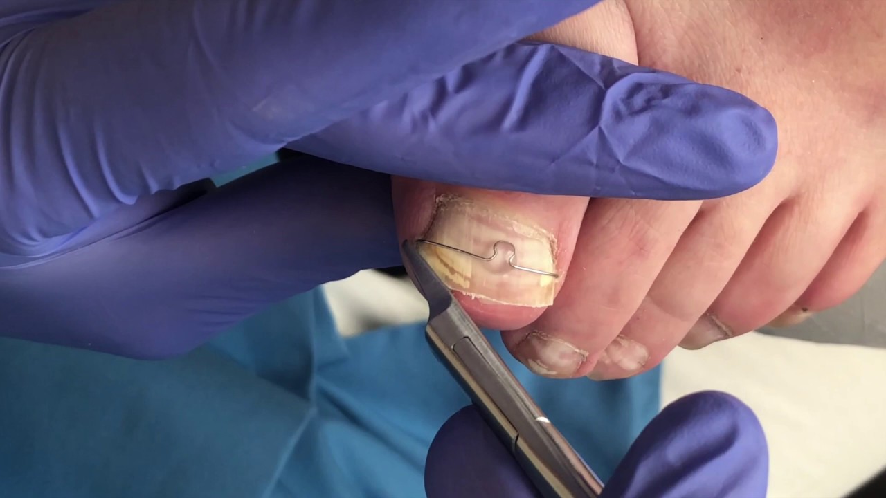 Przekładanie Klamry Frasera - podstawy ortonyksji