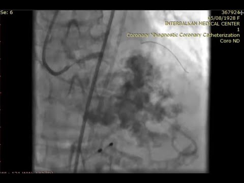 Combined Left Main PCI using Shockwave IVL and TAVI