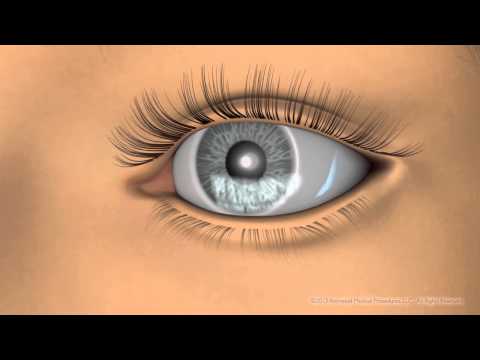 Tear Science LipiFlow Treatment at Mann Eye Institute