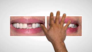 preview picture of video 'Dental Implants Battle Creek MI | Emergency Dental Implants'