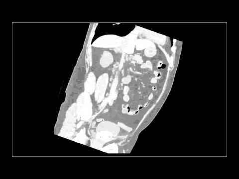 Jeune homme avec une pierre vésicale mystérieuse - rayons X et CT