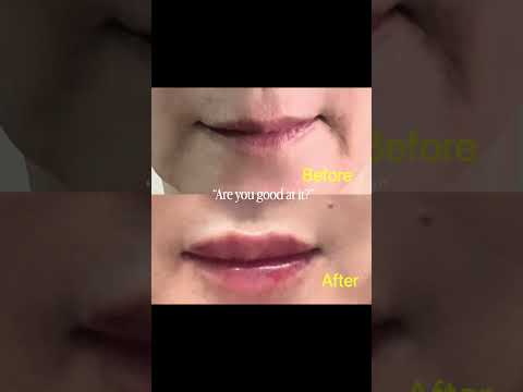Natural Lip Filler for Malaysian Singer Jazz