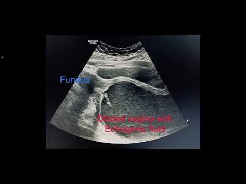 Classic case of imperforate hymen with hematocolpos