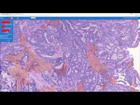 Qualitative Imaging Pathology (QuIP) - Lymphocyte detection using Deep Learning