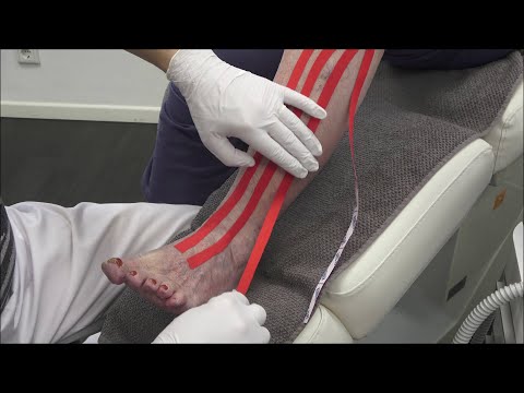 Podo Taping Concept© - Das Lymphtape