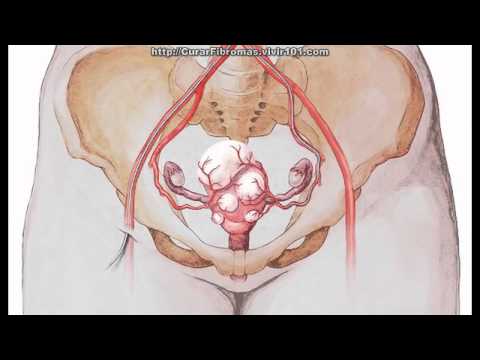 Como se curan los miomas en el utero
