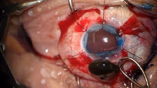 Black Cataract - Manual ICCE