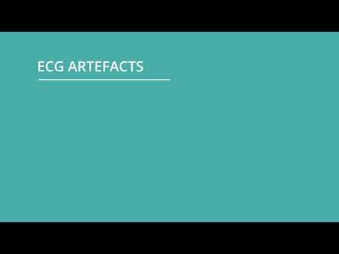 image-What is motion artifact in ECG?
