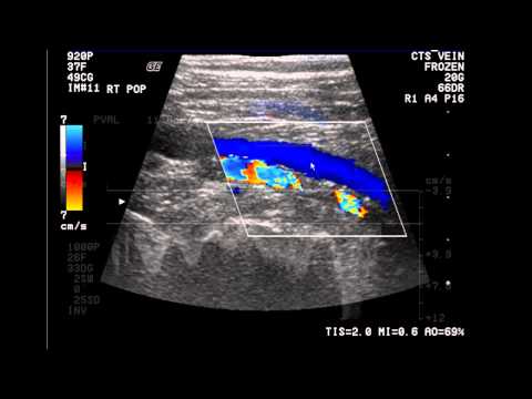 Introduction to the Lower Extremity Venous Doppler Study