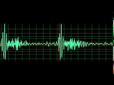 Mitral Regurgitation- normal speed