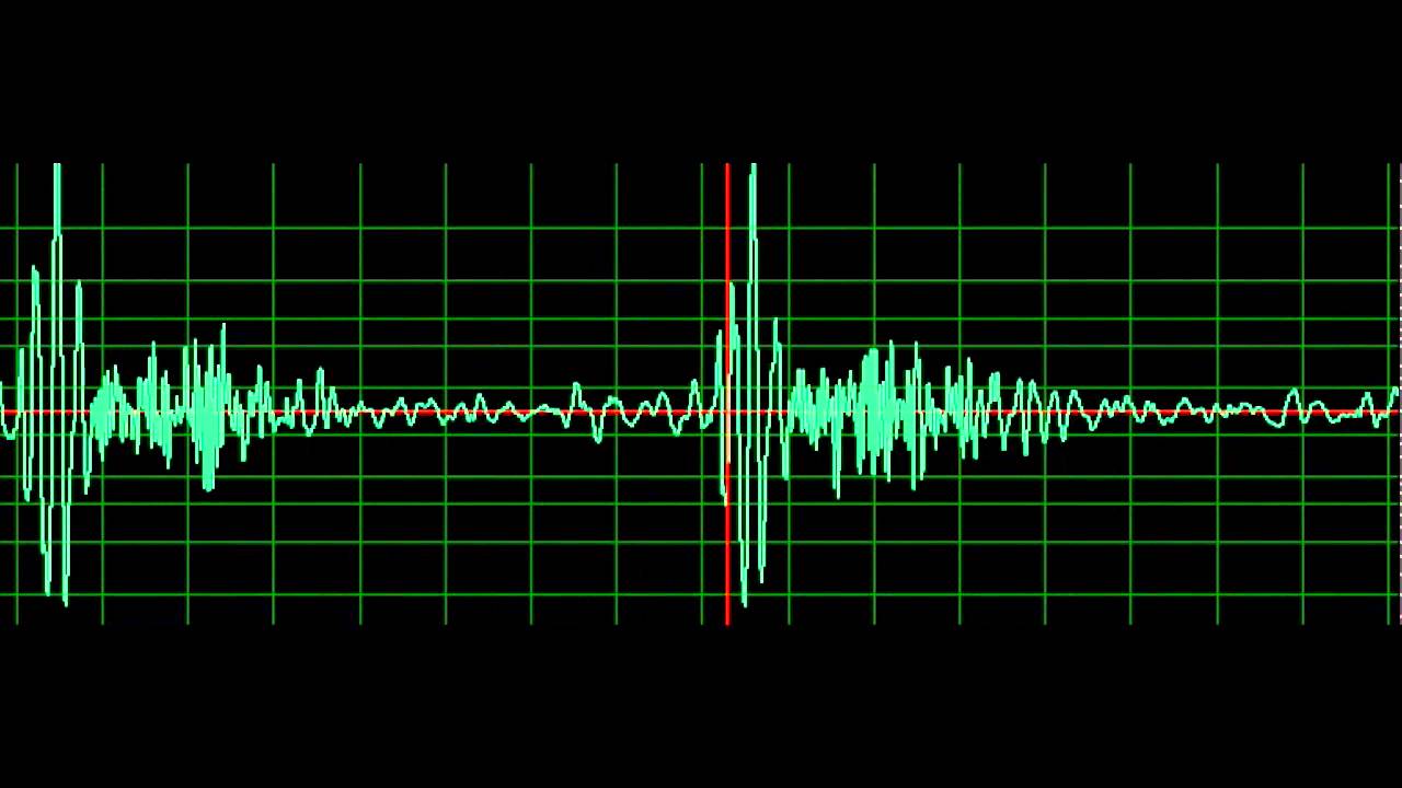 Mitral Regurgitation- normal speed