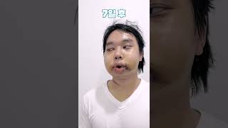 턱선 윤곽술 성형 시술