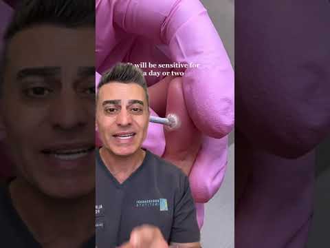 Wart Freezing: The Pros, Cons, and Results