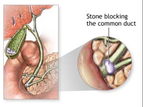 Choledocholithiasis & Cholangitis - YouTube
