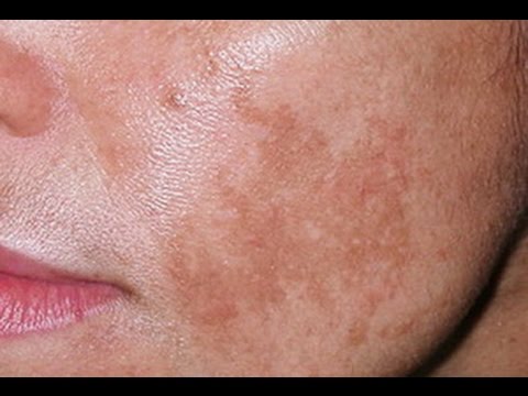 Веснушки как их скрывать Веснушки зеленые глаза макияж фото