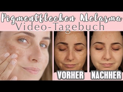 Pigmentflecken endlich loswerden Tagebuch I Melasma Altersflecken & Co #AntiPigment